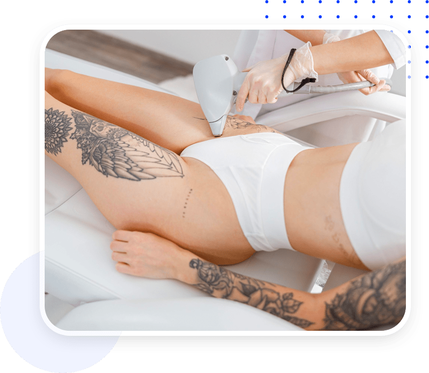 Das Bild zeigt eine Behandlung und dient als Titelbild für das Thema „Laser zur Tattooentfernung von Biotec Italia kaufen