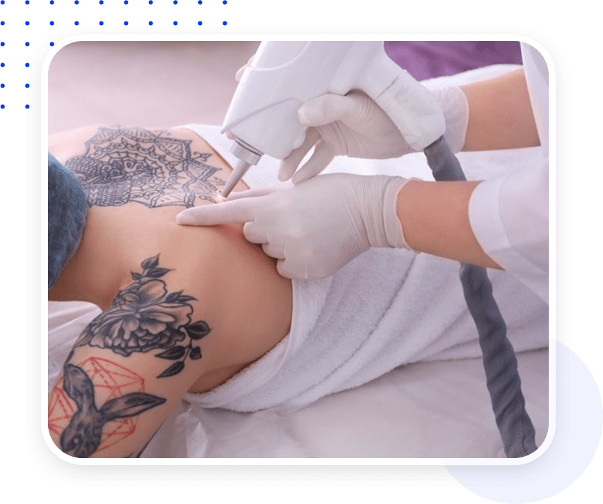 Das Bild zeigt Behandlung und dient als Beitragsbild zum Thema „Ein Tattoo lässt sich mit einem Laser entfernen“.